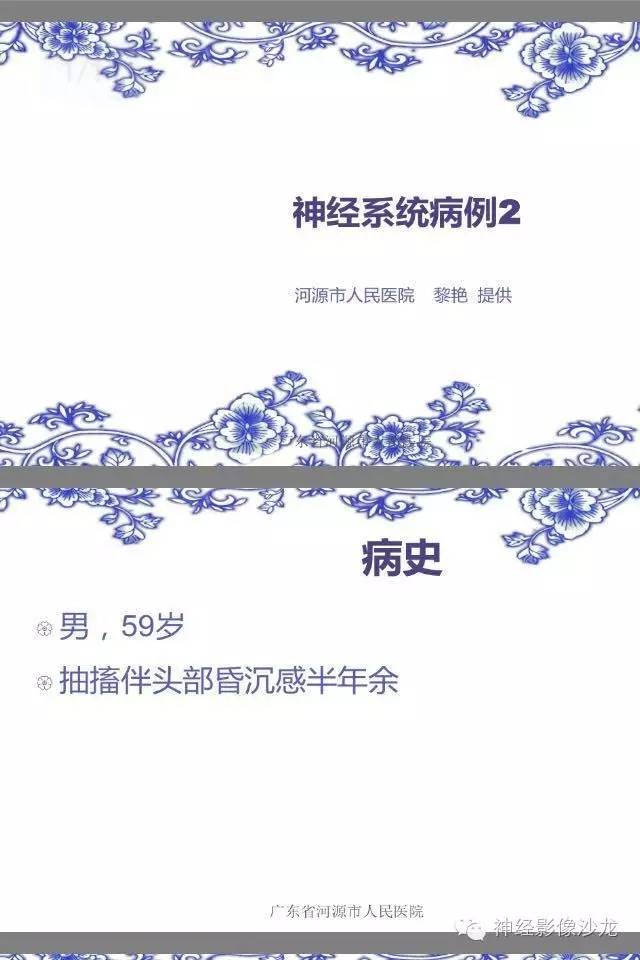 【病例】左额叶星形细胞瘤III级1例MR影像表现 【病例】左额叶星形细胞瘤III级1例MR影像表现