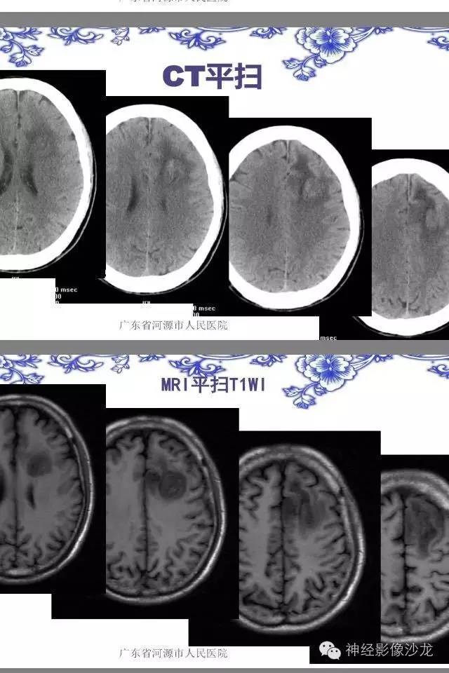 【病例】左额叶星形细胞瘤III级1例MR影像表现