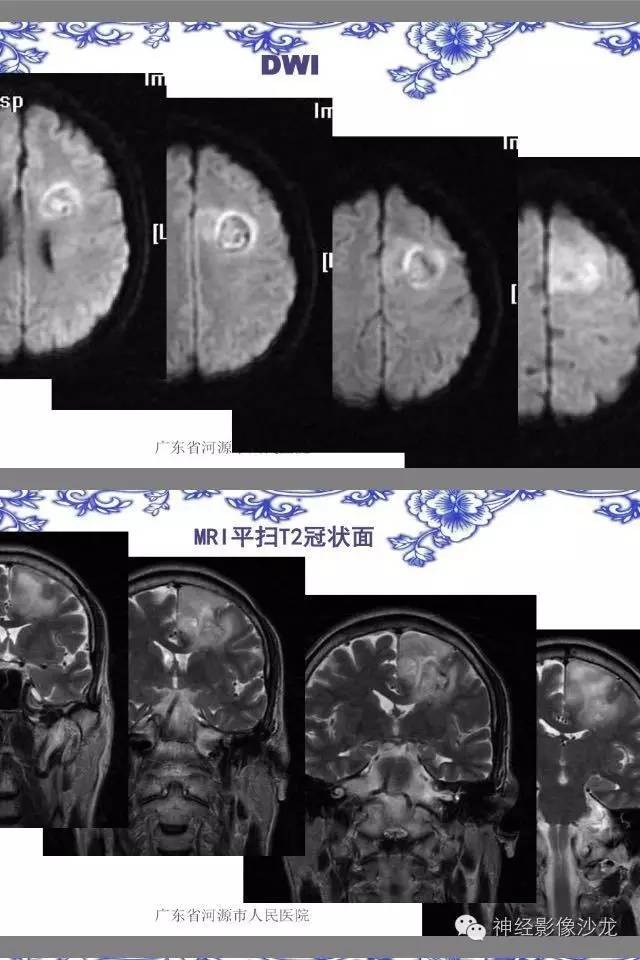 【病例】左额叶星形细胞瘤III级1例MR影像表现 【病例】左额叶星形细胞瘤III级1例MR影像表现