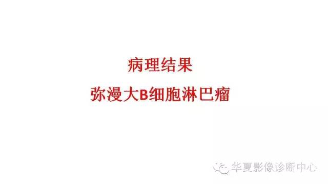 【病例】腹膜后淋巴瘤1例CT影像表现