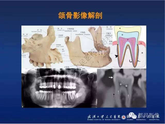 【PPT】颌骨囊肿和肿瘤CT&MRI