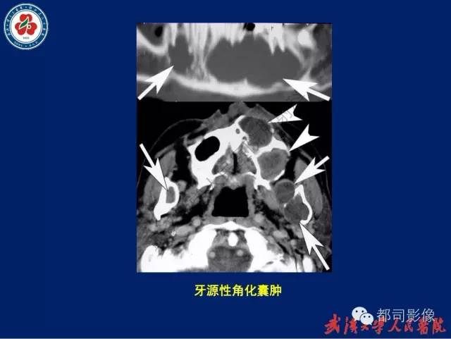 【PPT】颌骨囊肿和肿瘤CT&MRI