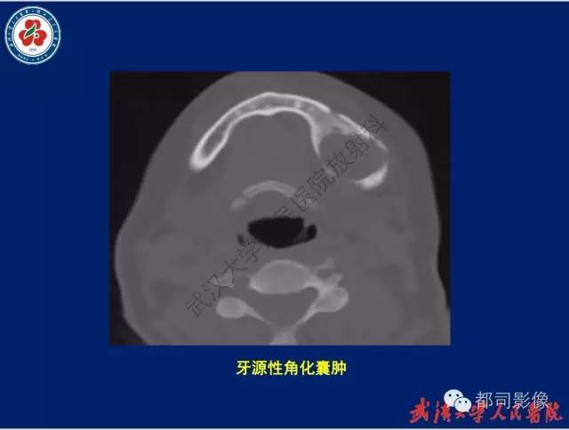 【PPT】颌骨囊肿和肿瘤CT&MRI