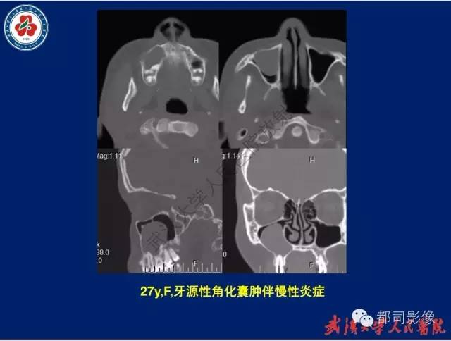 【PPT】颌骨囊肿和肿瘤CT&MRI
