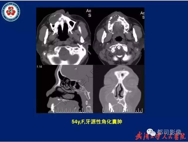 【PPT】颌骨囊肿和肿瘤CT&MRI
