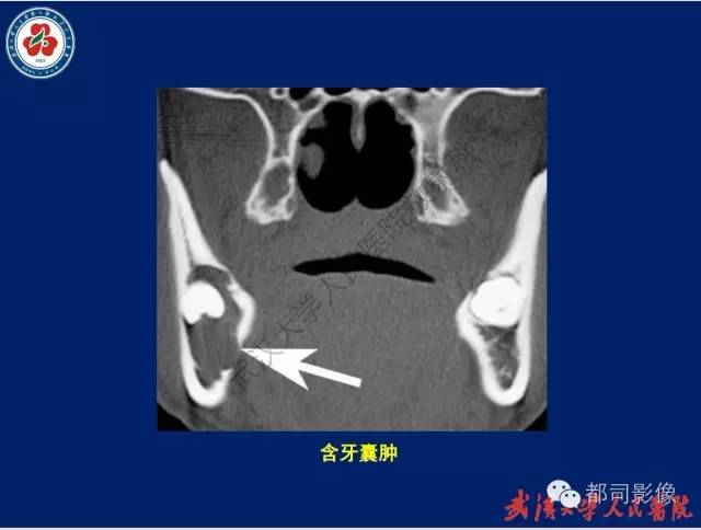 【PPT】颌骨囊肿和肿瘤CT&MRI