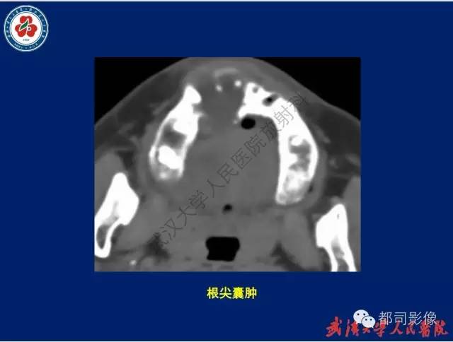 【PPT】颌骨囊肿和肿瘤CT&MRI