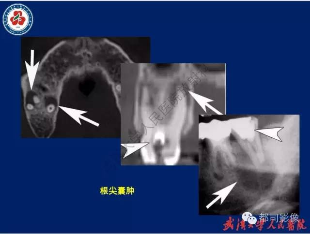 【PPT】颌骨囊肿和肿瘤CT&MRI