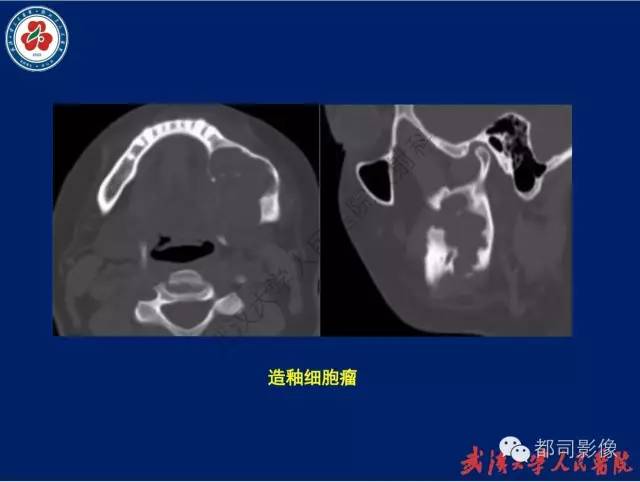 【PPT】颌骨囊肿和肿瘤CT&MRI
