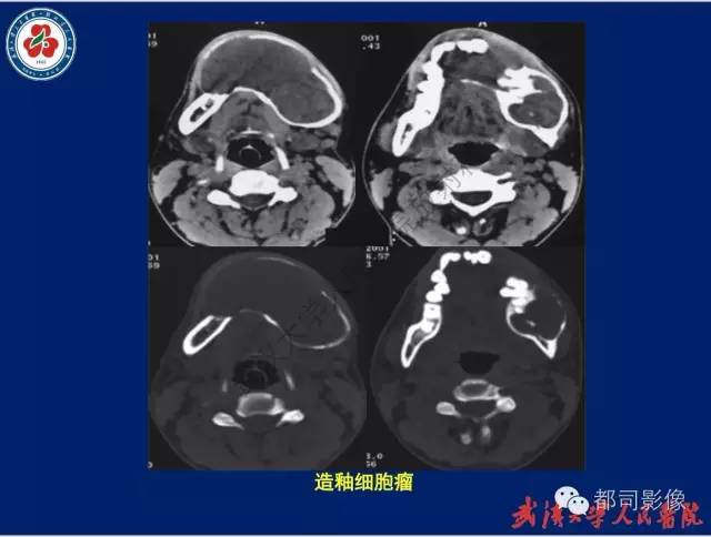 【PPT】颌骨囊肿和肿瘤CT&MRI