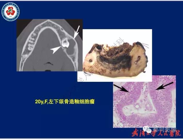 【PPT】颌骨囊肿和肿瘤CT&MRI