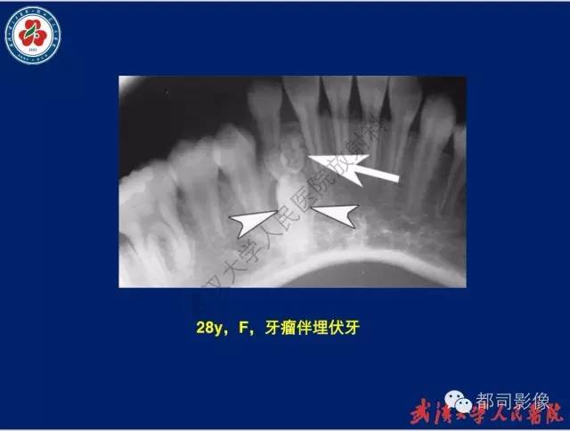 【PPT】颌骨囊肿和肿瘤CT&MRI