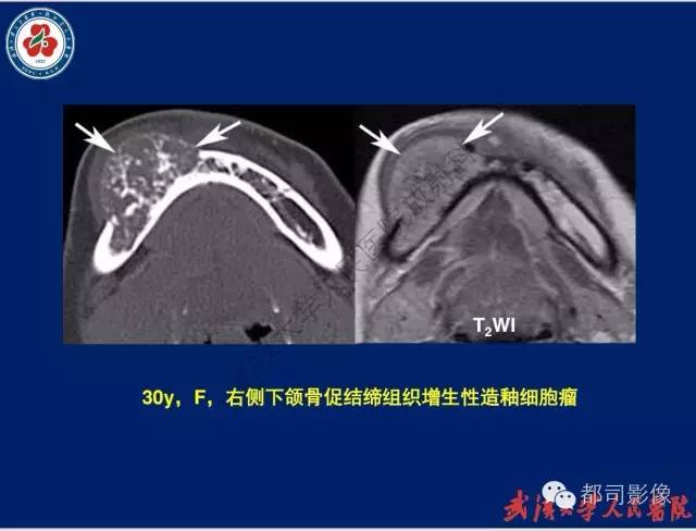 【PPT】颌骨囊肿和肿瘤CT&MRI