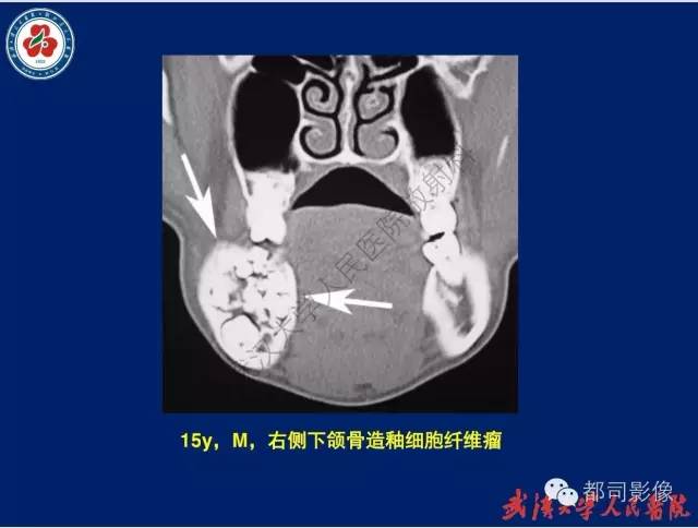 【PPT】颌骨囊肿和肿瘤CT&MRI