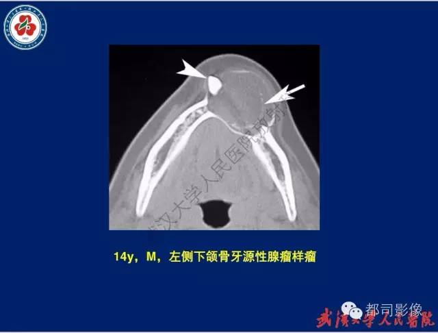 【PPT】颌骨囊肿和肿瘤CT&MRI
