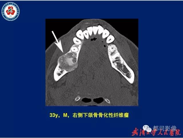 【PPT】颌骨囊肿和肿瘤CT&MRI