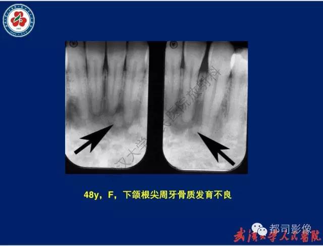 【PPT】颌骨囊肿和肿瘤CT&MRI