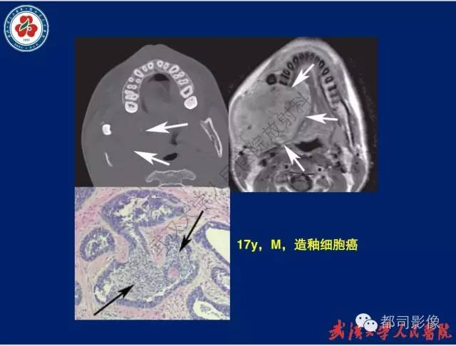 【PPT】颌骨囊肿和肿瘤CT&MRI