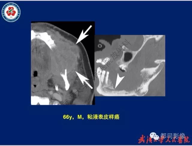 【PPT】颌骨囊肿和肿瘤CT&MRI