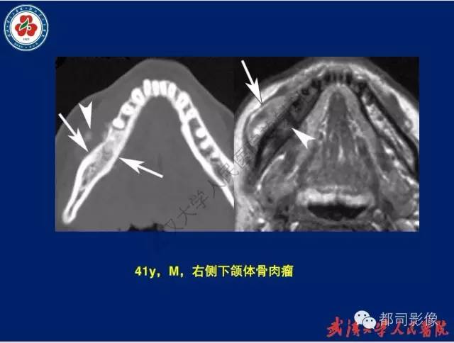 【PPT】颌骨囊肿和肿瘤CT&MRI