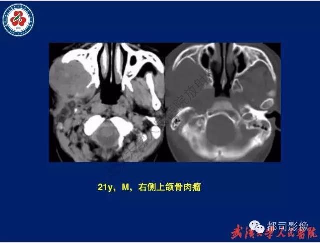 【PPT】颌骨囊肿和肿瘤CT&MRI