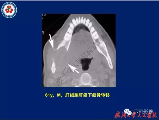 【PPT】颌骨囊肿和肿瘤CT&MRI