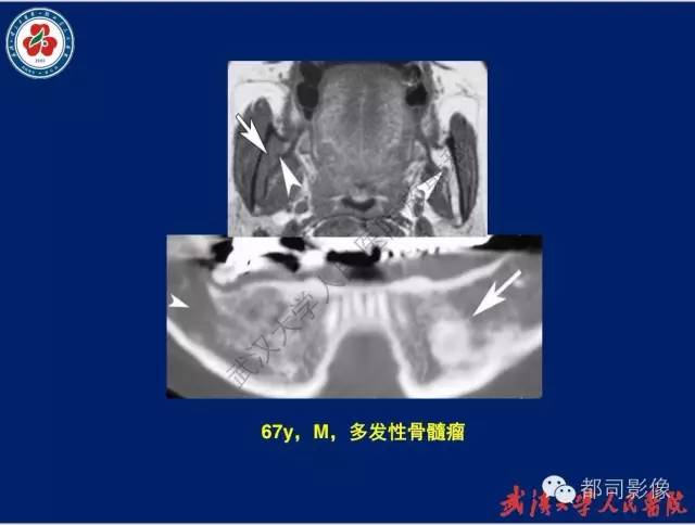 【PPT】颌骨囊肿和肿瘤CT&MRI