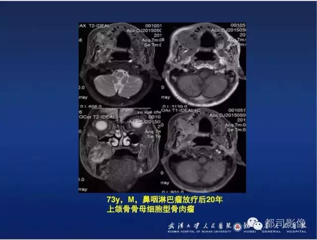 【PPT】颌骨囊肿和肿瘤CT&MRI