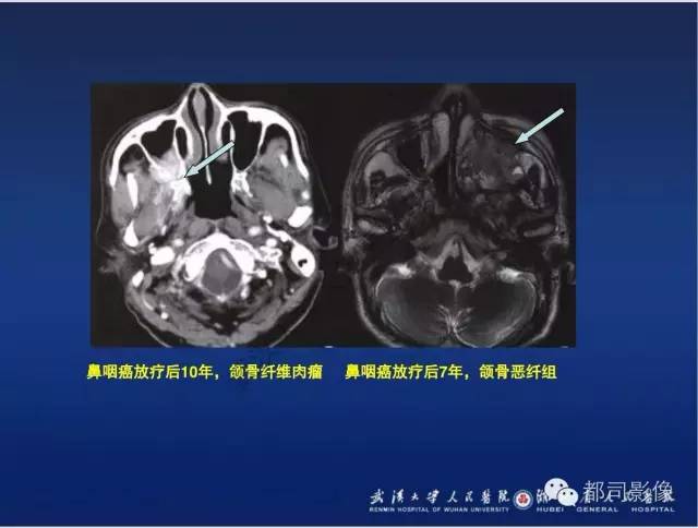 【PPT】颌骨囊肿和肿瘤CT&MRI