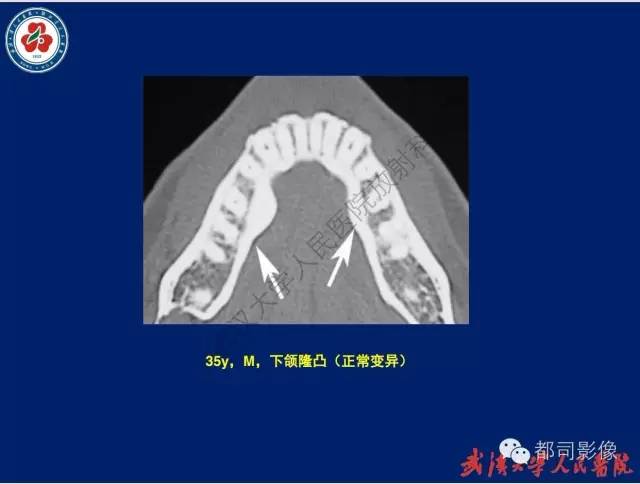 【PPT】颌骨囊肿和肿瘤CT&MRI