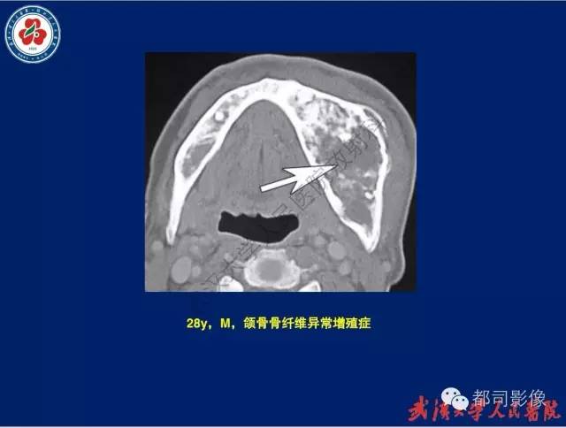 【PPT】颌骨囊肿和肿瘤CT&MRI