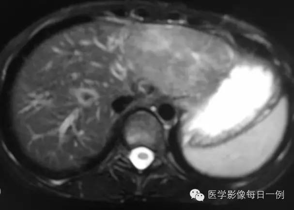 【病例】肝巨大局灶结节样增生1例MR影像表现