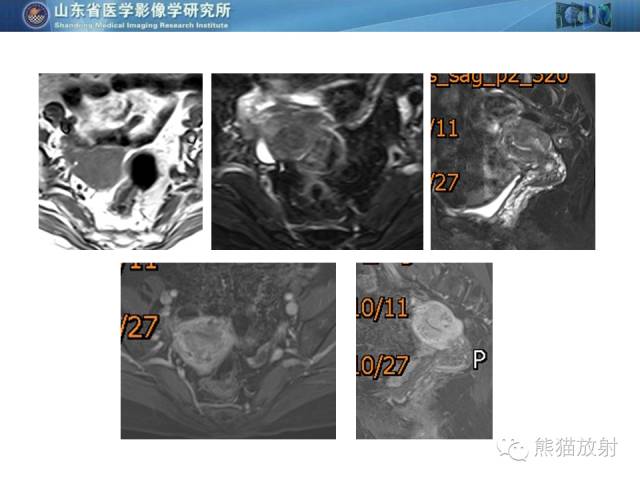 【PPT】盆腔影像检查技术及诊断的培训要点