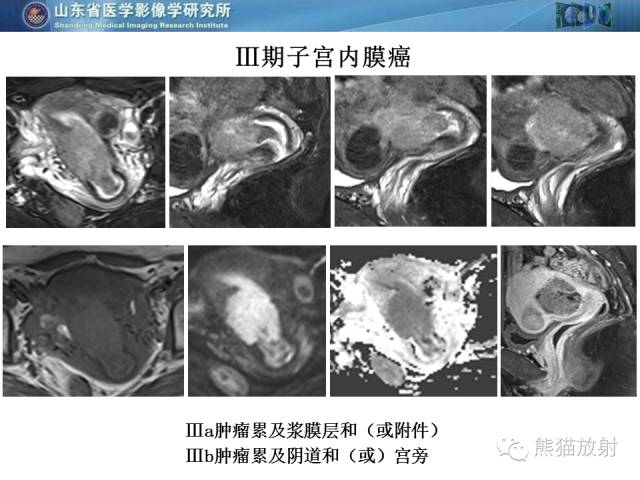 【PPT】盆腔影像检查技术及诊断的培训要点