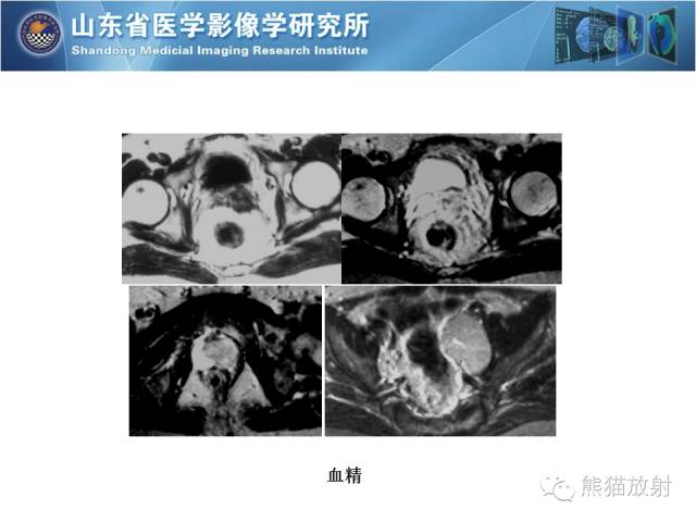 【PPT】盆腔影像检查技术及诊断的培训要点
