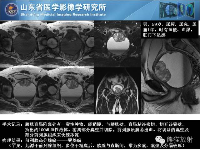 【PPT】盆腔影像检查技术及诊断的培训要点