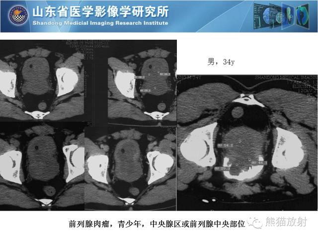 【PPT】盆腔影像检查技术及诊断的培训要点