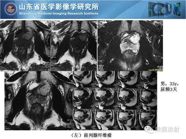 【PPT】盆腔影像检查技术及诊断的培训要点