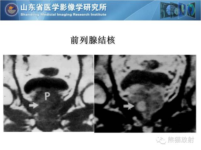 【PPT】盆腔影像检查技术及诊断的培训要点