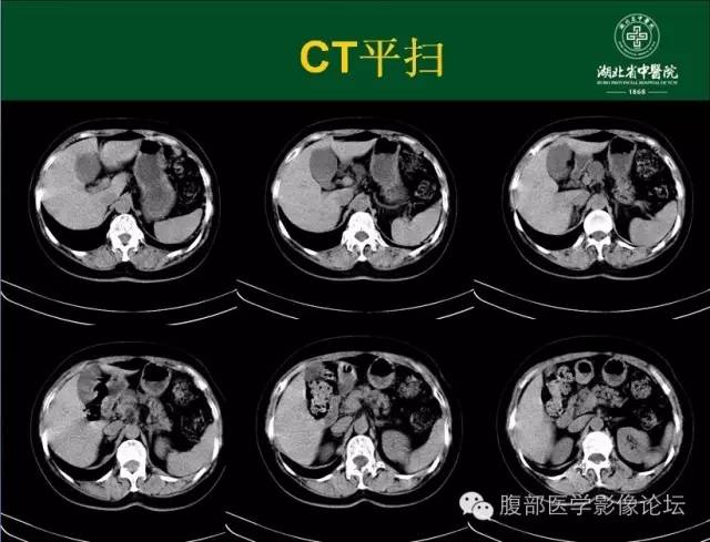 【病例】胰腺浆液性囊腺瘤1例CT影像表现 【病例】胰腺浆液性囊腺瘤1例CT影像表现
