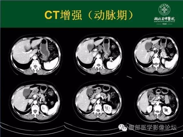 【病例】胰腺浆液性囊腺瘤1例CT影像表现 【病例】胰腺浆液性囊腺瘤1例CT影像表现