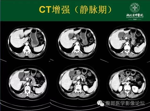 【病例】胰腺浆液性囊腺瘤1例CT影像表现 【病例】胰腺浆液性囊腺瘤1例CT影像表现