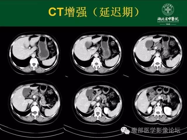 【病例】胰腺浆液性囊腺瘤1例CT影像表现 【病例】胰腺浆液性囊腺瘤1例CT影像表现
