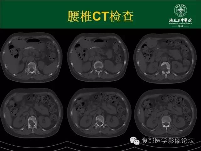 【病例】腰椎结核1例CT及MR影像表现 【病例】腰椎结核1例CT及MR影像表现