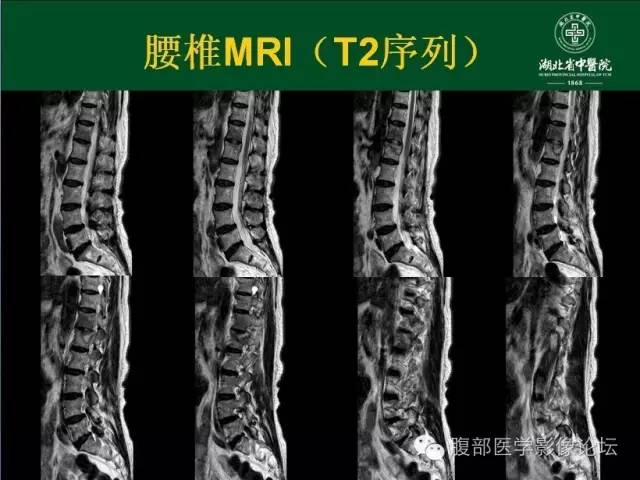 【病例】腰椎结核1例CT及MR影像表现 【病例】腰椎结核1例CT及MR影像表现
