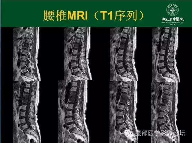 【病例】腰椎结核1例CT及MR影像表现 【病例】腰椎结核1例CT及MR影像表现