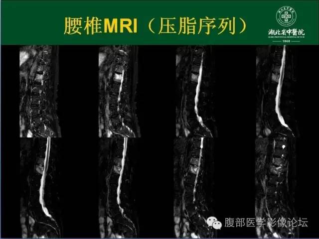 【病例】腰椎结核1例CT及MR影像表现 【病例】腰椎结核1例CT及MR影像表现