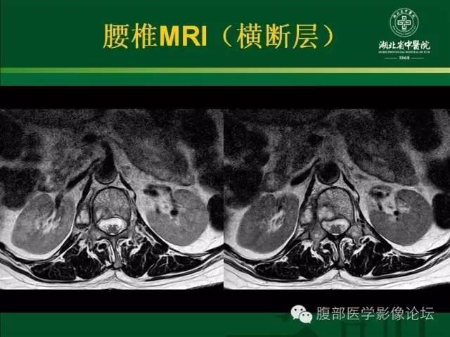 【病例】腰椎结核1例CT及MR影像表现 【病例】腰椎结核1例CT及MR影像表现