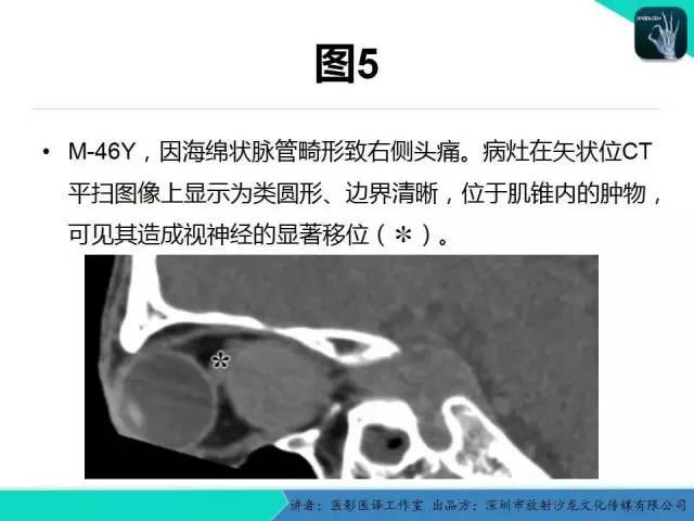 【PPT】成人眼眶肿瘤：临床、影像、与病理回顾