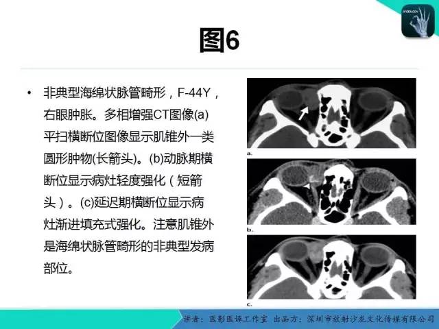 【PPT】成人眼眶肿瘤：临床、影像、与病理回顾